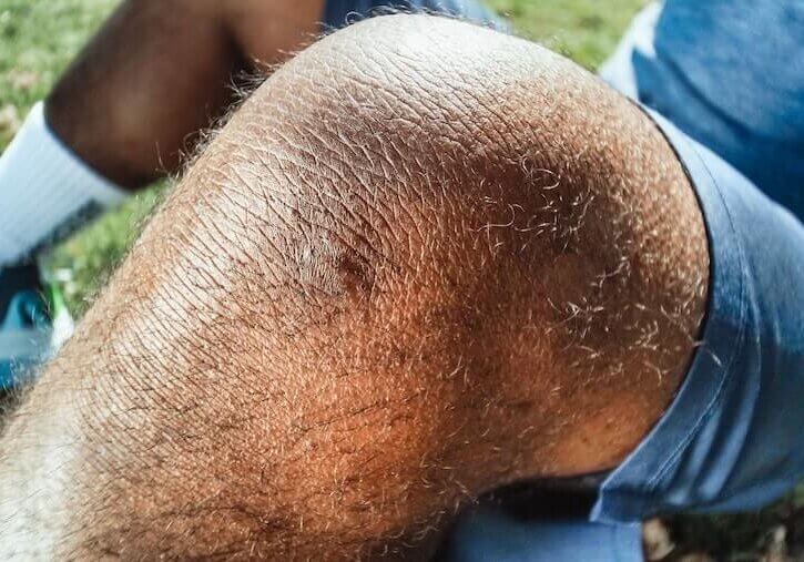 knee-replacement-surgery-physical-therapy-reading-pa